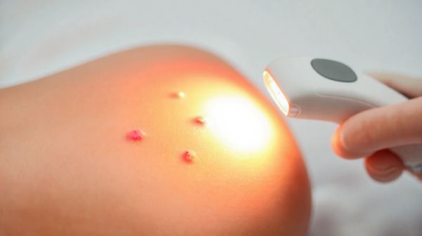 Les bienfaits de la photobiomodulation pour la cicatrisation